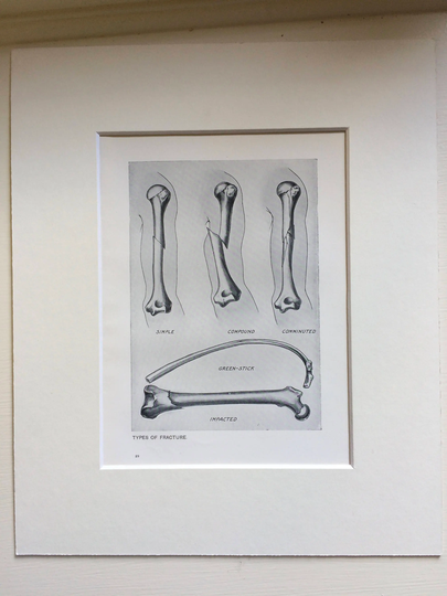 1920S Original Antique Matted Anatomical Print - Types Of Fracture | Simple, Compound, Comminuted, Green Stick, Impacted Anatomy Medicine