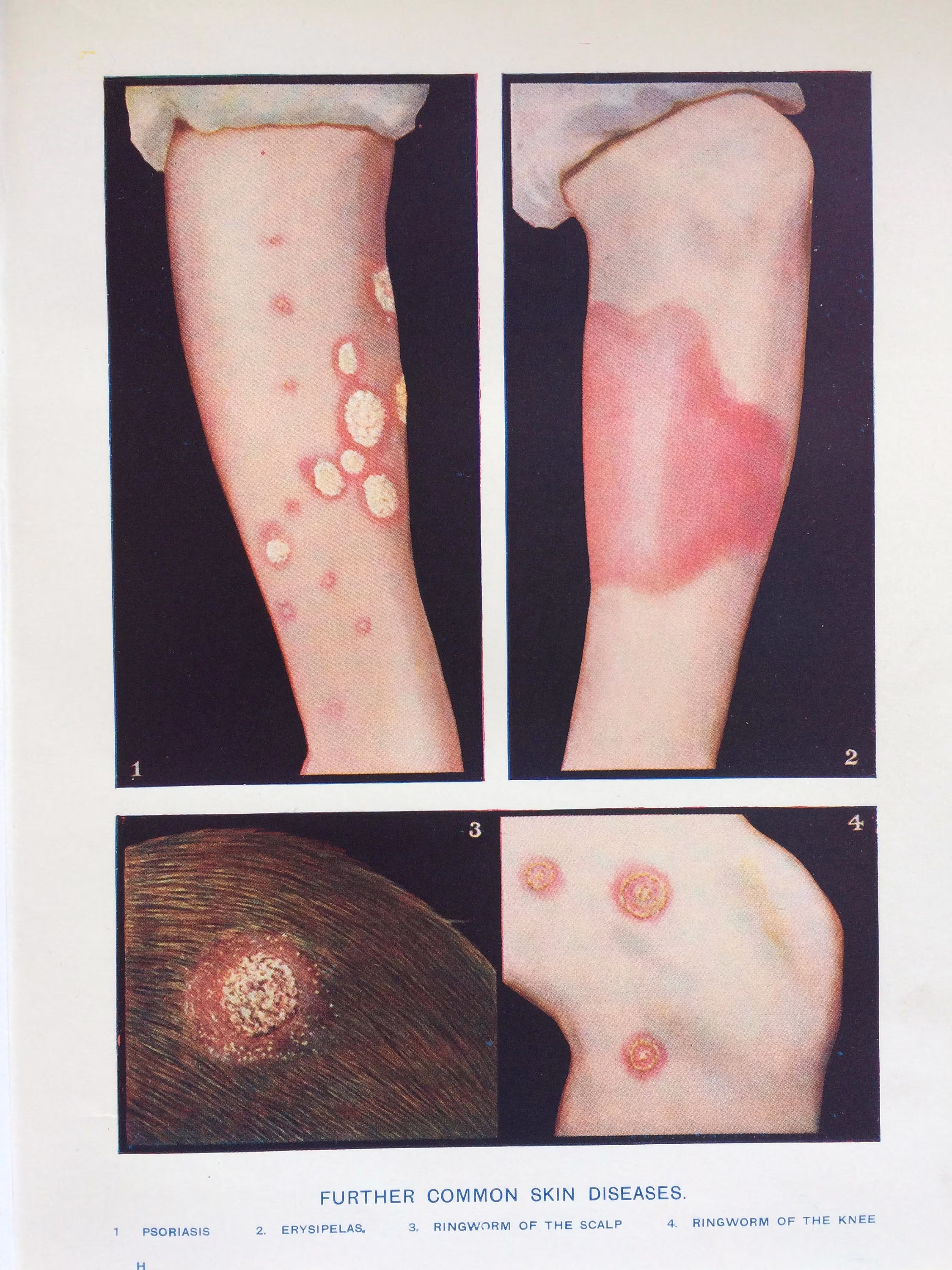 1920S Original Antique Matted Anatomical Print - Further Common Skin Diseases Anatomy Medicine Psoriasis, Erysipelas, Ringworm